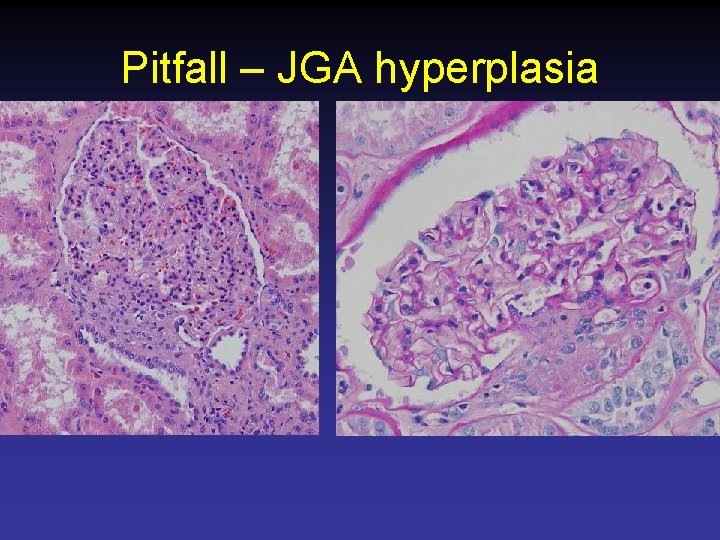 Pitfall – JGA hyperplasia 