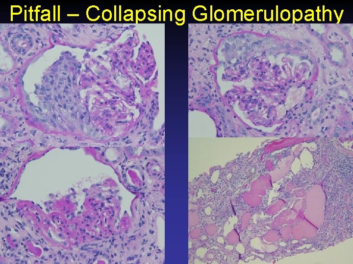 Pitfall – Collapsing Glomerulopathy 