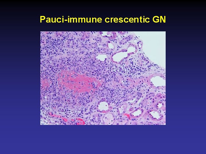 Pauci-immune crescentic GN 