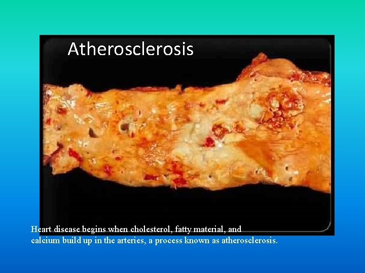 Atherosclerosis Heart disease begins when cholesterol, fatty material, and calcium build up in the