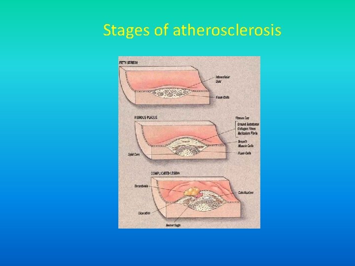 Stages of atherosclerosis 