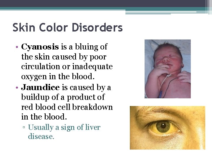 Skin Color Disorders • Cyanosis is a bluing of the skin caused by poor