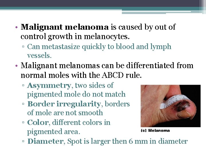  • Malignant melanoma is caused by out of control growth in melanocytes. ▫