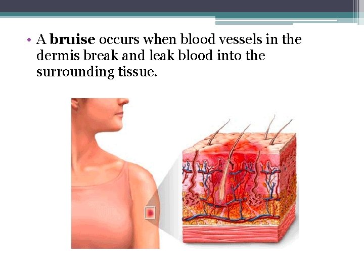  • A bruise occurs when blood vessels in the dermis break and leak