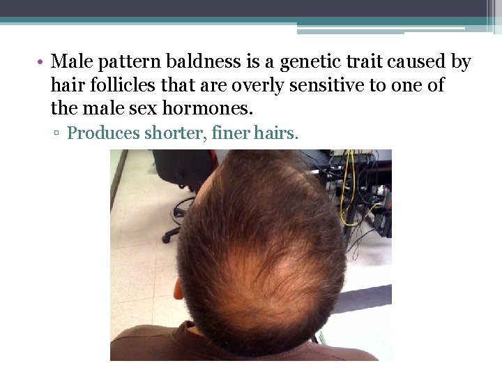  • Male pattern baldness is a genetic trait caused by hair follicles that