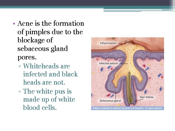  • Acne is the formation of pimples due to the blockage of sebaceous