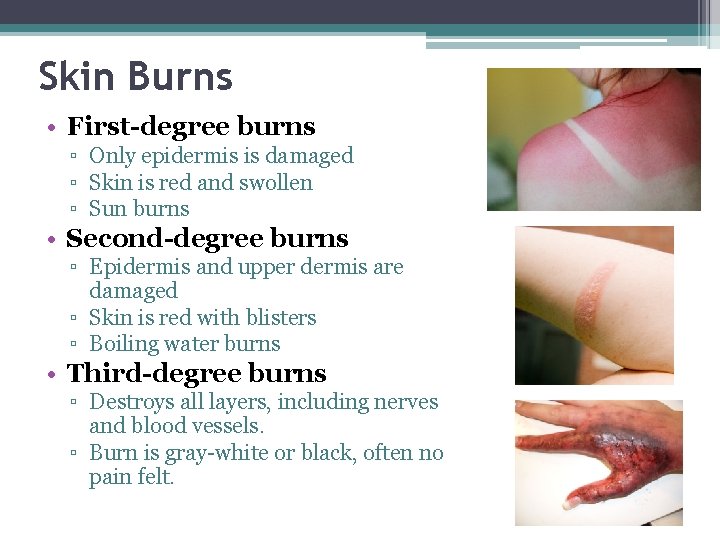 Skin Burns • First-degree burns ▫ Only epidermis is damaged ▫ Skin is red