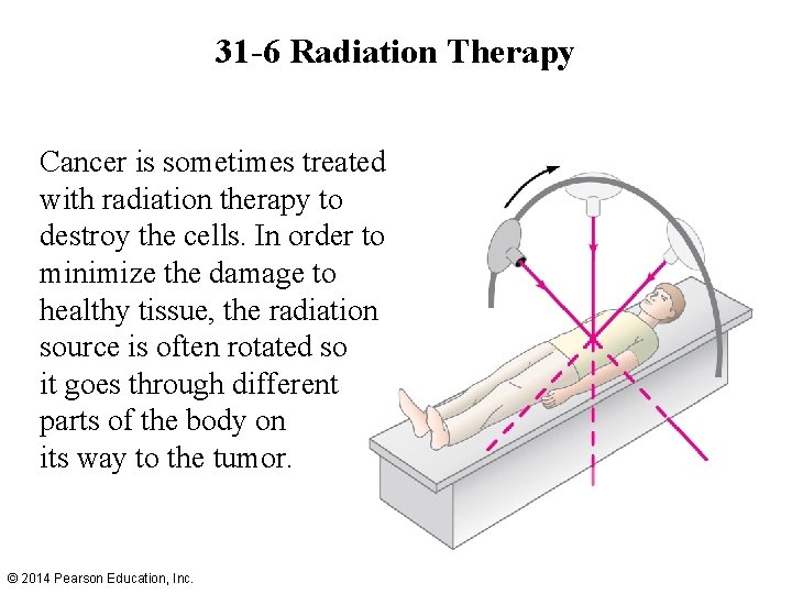 31 -6 Radiation Therapy Cancer is sometimes treated with radiation therapy to destroy the