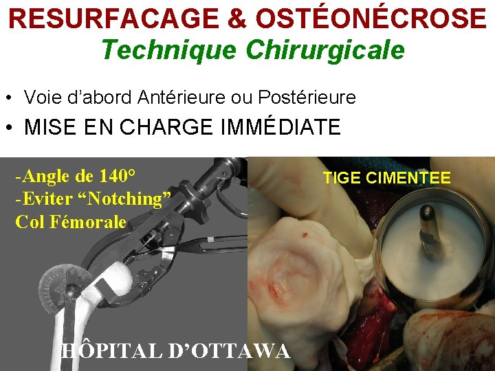 RESURFACAGE & OSTÉONÉCROSE Technique Chirurgicale • Voie d’abord Antérieure ou Postérieure • MISE EN RESURFACAGE & OSTÉONÉCROSE Technique Chirurgicale • Voie d’abord Antérieure ou Postérieure • MISE EN