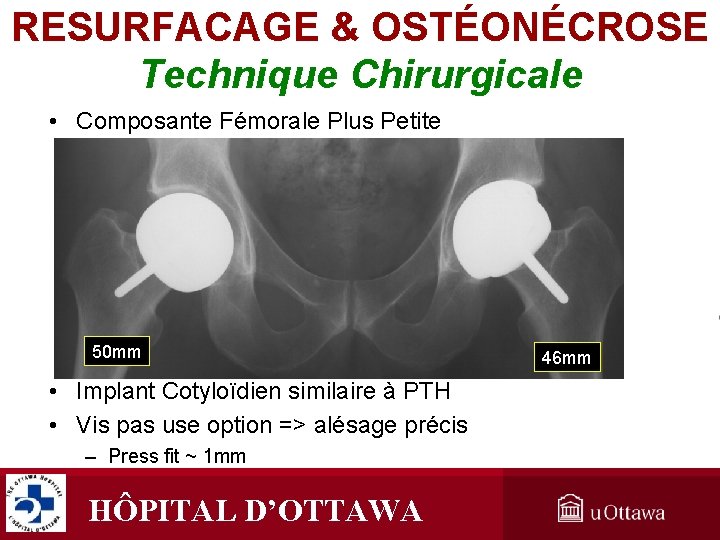 RESURFACAGE & OSTÉONÉCROSE Technique Chirurgicale • Composante Fémorale Plus Petite 50 mm • Implant RESURFACAGE & OSTÉONÉCROSE Technique Chirurgicale • Composante Fémorale Plus Petite 50 mm • Implant