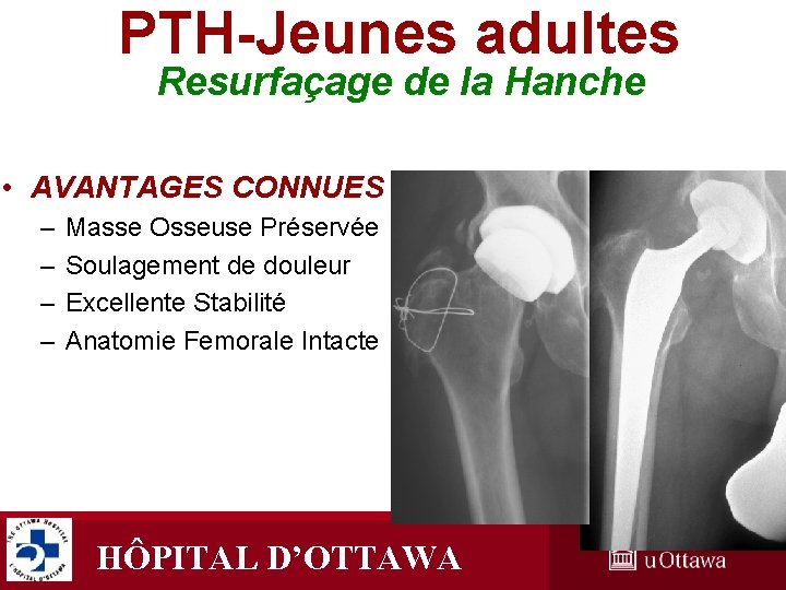 PTH-Jeunes adultes Resurfaçage de la Hanche • AVANTAGES CONNUES – – Masse Osseuse Préservée PTH-Jeunes adultes Resurfaçage de la Hanche • AVANTAGES CONNUES – – Masse Osseuse Préservée