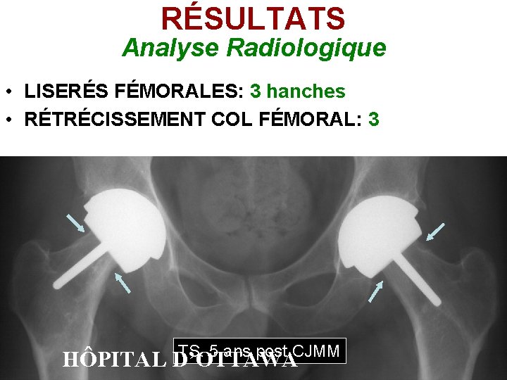 RÉSULTATS Analyse Radiologique • LISERÉS FÉMORALES: 3 hanches • RÉTRÉCISSEMENT COL FÉMORAL: 3 TS. RÉSULTATS Analyse Radiologique • LISERÉS FÉMORALES: 3 hanches • RÉTRÉCISSEMENT COL FÉMORAL: 3 TS.
