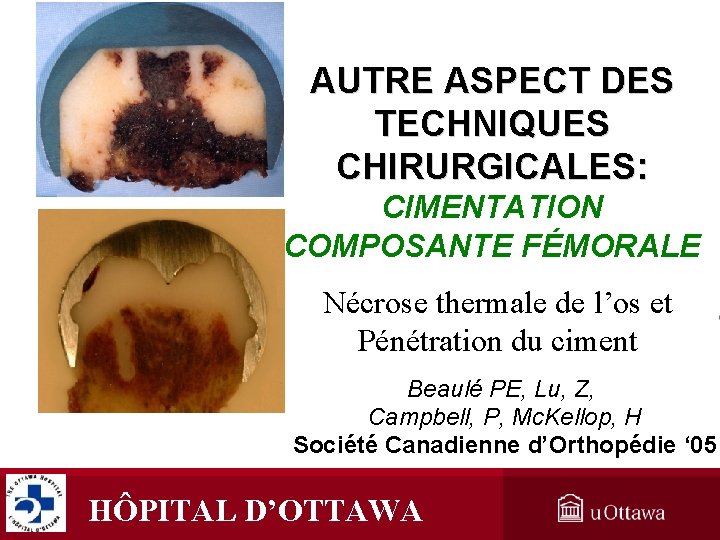 AUTRE ASPECT DES TECHNIQUES CHIRURGICALES: CIMENTATION COMPOSANTE FÉMORALE Nécrose thermale de l’os et Pénétration AUTRE ASPECT DES TECHNIQUES CHIRURGICALES: CIMENTATION COMPOSANTE FÉMORALE Nécrose thermale de l’os et Pénétration