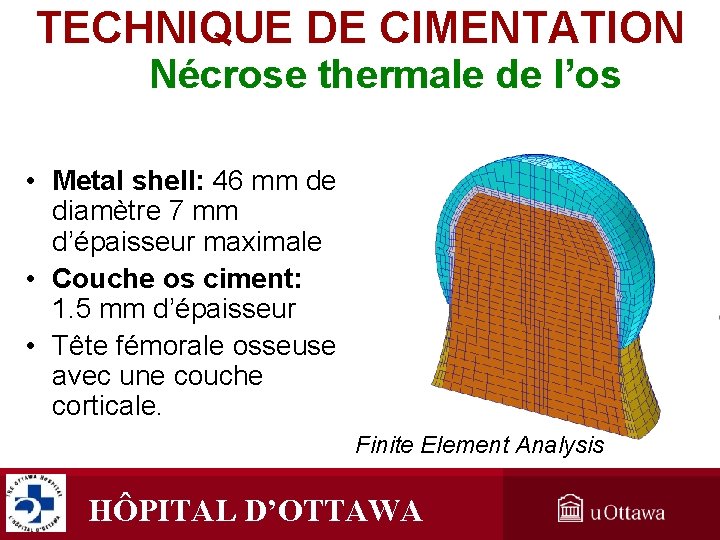 TECHNIQUE DE CIMENTATION Nécrose thermale de l’os • Metal shell: 46 mm de diamètre TECHNIQUE DE CIMENTATION Nécrose thermale de l’os • Metal shell: 46 mm de diamètre