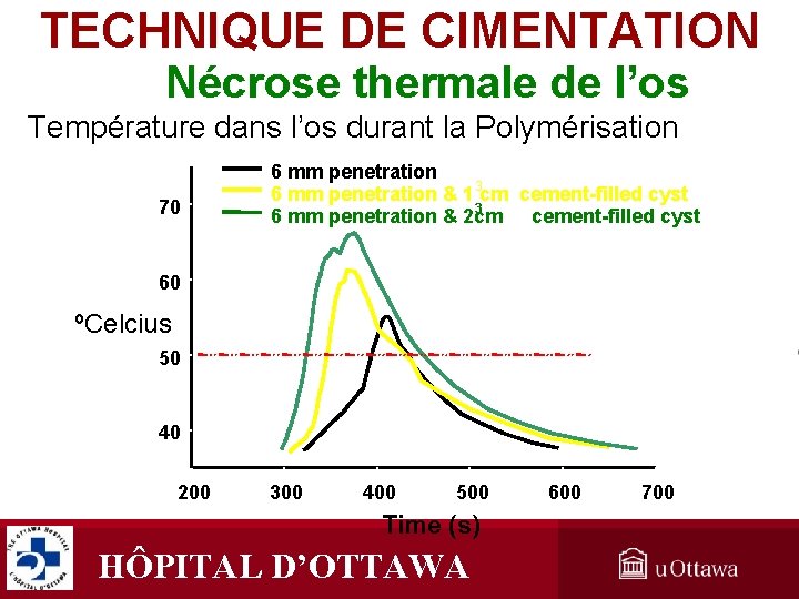 TECHNIQUE DE CIMENTATION Nécrose thermale de l’os Température dans l’os durant la Polymérisation 70 TECHNIQUE DE CIMENTATION Nécrose thermale de l’os Température dans l’os durant la Polymérisation 70