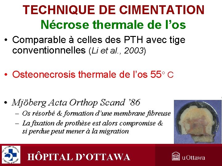 TECHNIQUE DE CIMENTATION Nécrose thermale de l’os • Comparable à celles des PTH avec TECHNIQUE DE CIMENTATION Nécrose thermale de l’os • Comparable à celles des PTH avec