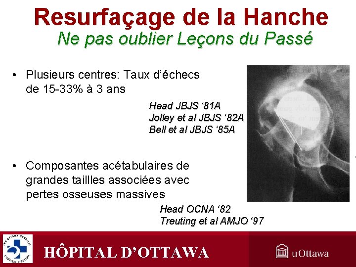 Resurfaçage de la Hanche Ne pas oublier Leçons du Passé • Plusieurs centres: Taux Resurfaçage de la Hanche Ne pas oublier Leçons du Passé • Plusieurs centres: Taux