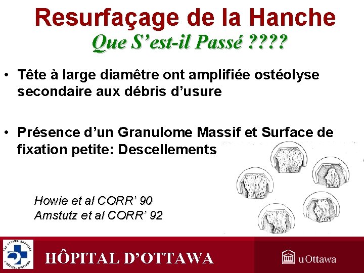 Resurfaçage de la Hanche Que S’est-il Passé ? ? • Tête à large diamêtre Resurfaçage de la Hanche Que S’est-il Passé ? ? • Tête à large diamêtre