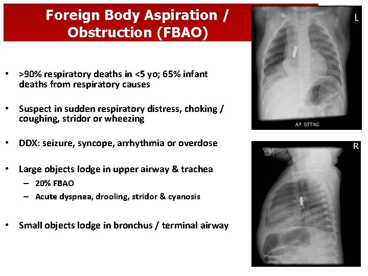 Foreign Body Aspiration / Obstruction (FBAO) • >90% respiratory deaths in <5 yo; 65%