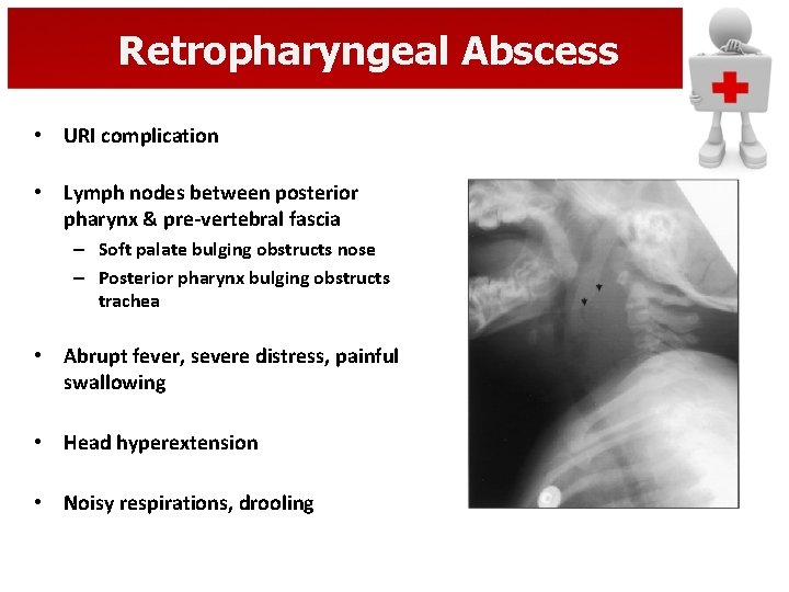 Retropharyngeal Abscess • URI complication • Lymph nodes between posterior pharynx & pre-vertebral fascia