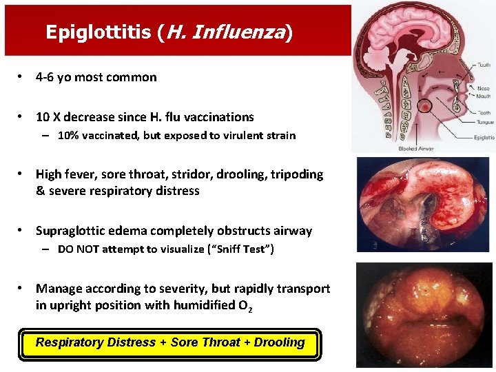 Epiglottitis (H. Influenza) • 4 -6 yo most common • 10 X decrease since