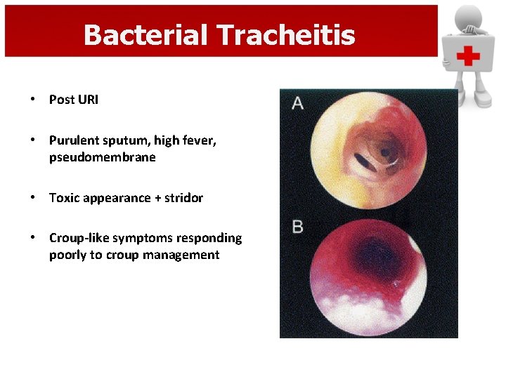 Bacterial Tracheitis • Post URI • Purulent sputum, high fever, pseudomembrane • Toxic appearance