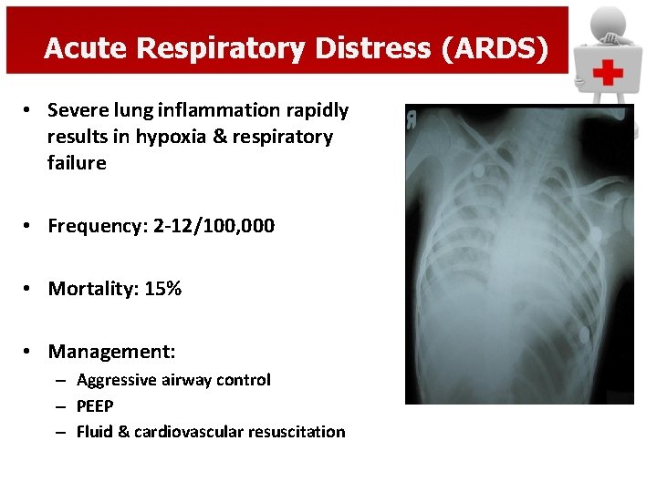 Acute Respiratory Distress (ARDS) • Severe lung inflammation rapidly results in hypoxia & respiratory