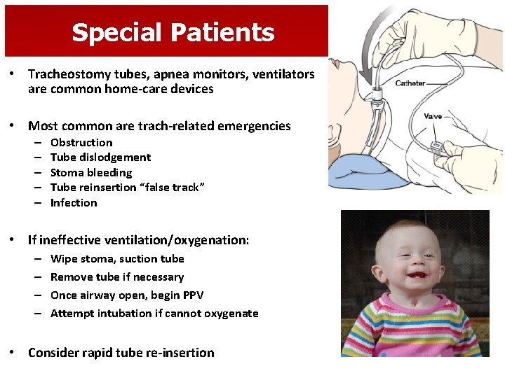 Special Patients • Tracheostomy tubes, apnea monitors, ventilators are common home-care devices • Most