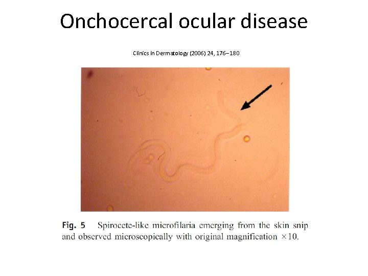 Onchocercal ocular disease Clinics in Dermatology (2006) 24, 176– 180 