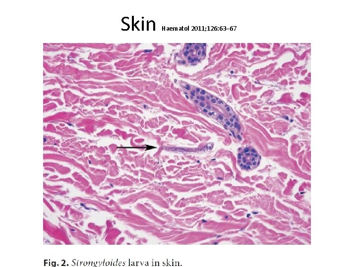 Skin Haematol 2011; 126: 63– 67 