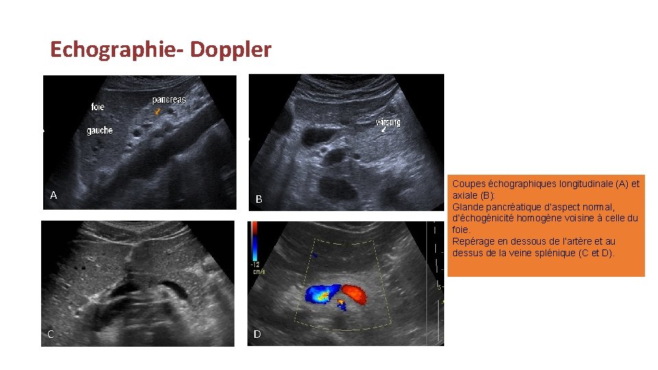 Echographie- Doppler A B C D Coupes échographiques longitudinale (A) et axiale (B): Glande