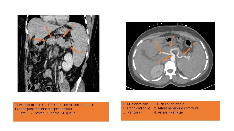 2 3 1 3 2 4 4 1 TDM abdominale C+ TP en reconstruction