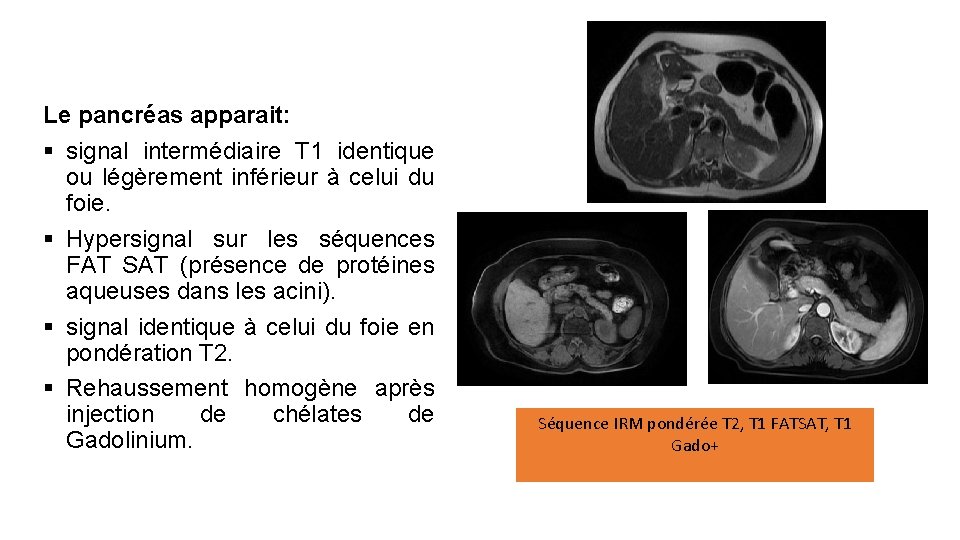 Le pancréas apparait: § signal intermédiaire T 1 identique ou légèrement inférieur à celui