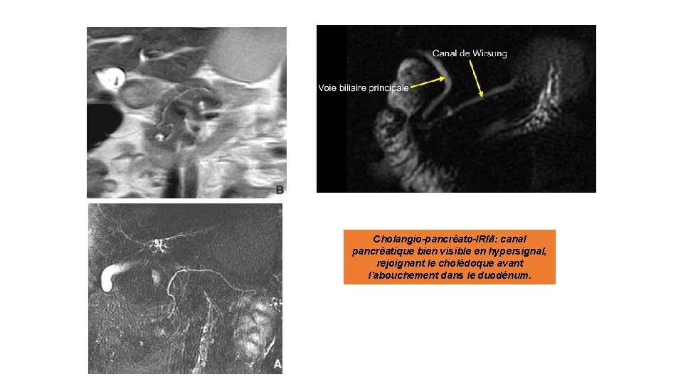 Cholangio-pancréato-IRM: canal pancréatique bien visible en hypersignal, rejoignant le cholédoque avant l’abouchement dans le