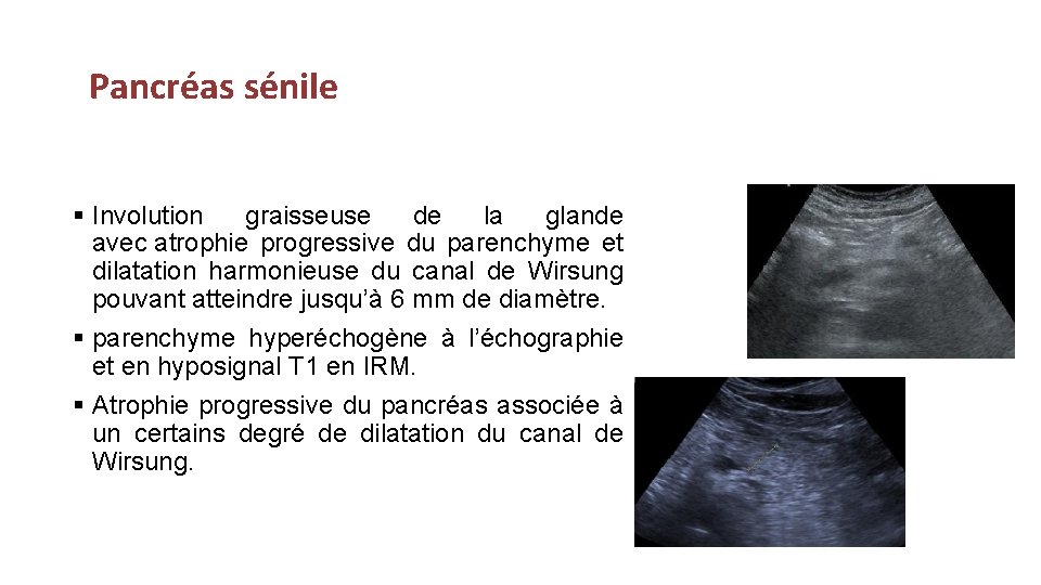  Pancréas sénile § Involution graisseuse de la glande avec atrophie progressive du parenchyme