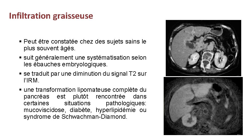 Infiltration graisseuse § Peut être constatée chez des sujets sains le plus souvent âgés.
