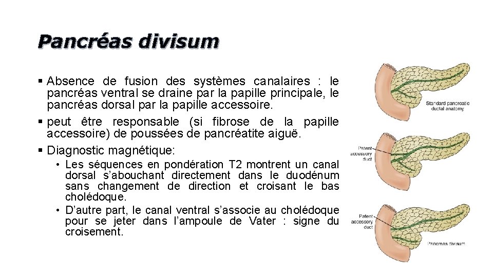 Pancréas divisum § Absence de fusion des systèmes canalaires : le pancréas ventral se