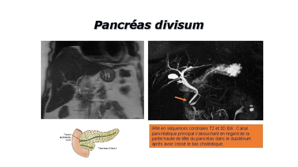 Pancréas divisum IRM en séquences coronales T 2 et 3 D Bili : Canal