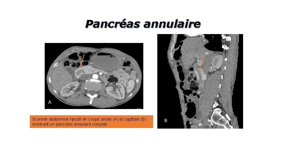 Pancréas annulaire A Scanner abdominal injecté en coupe axiale (A) et sagittale (B) montrant