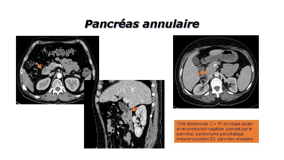 Pancréas annulaire TDM abdominale C+ TP en coupe axiale et reconstruction sagittale passant par