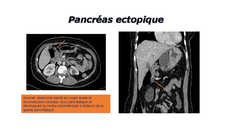 Pancréas ectopique Scanner abdominal injecté en coupe axiale et reconstruction coronale: tissu pancréatique se