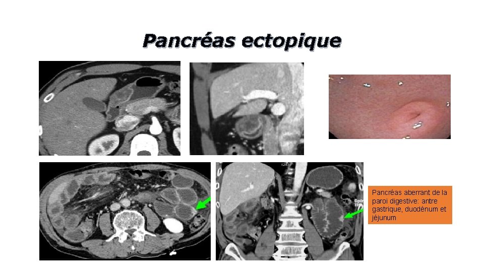 Pancréas ectopique Pancréas aberrant de la paroi digestive: antre gastrique, duodénum et jéjunum 