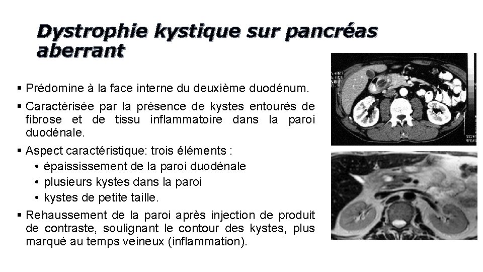 Dystrophie kystique sur pancréas aberrant § Prédomine à la face interne du deuxième duodénum.