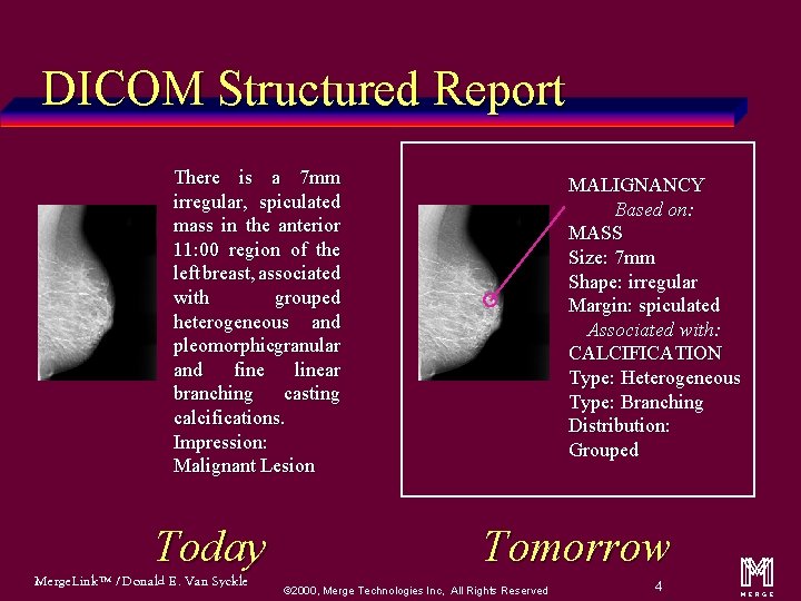 DICOM Structured Report There is a 7 mm irregular, spiculated mass in the anterior