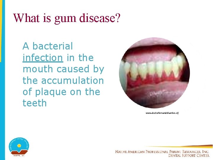 What is gum disease? A bacterial infection in the mouth caused by the accumulation