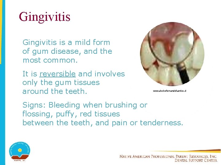 Gingivitis is a mild form of gum disease, and the most common. It is