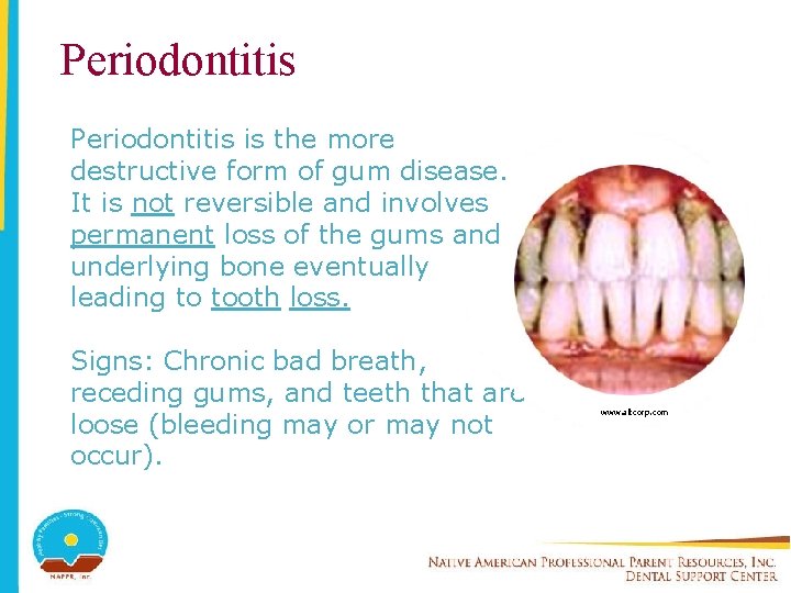 Periodontitis is the more destructive form of gum disease. It is not reversible and
