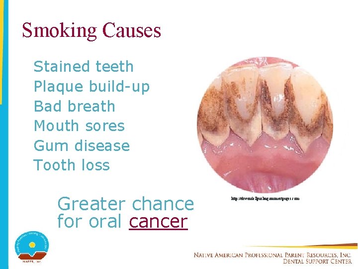 Smoking Causes Stained teeth Plaque build-up Bad breath Mouth sores Gum disease Tooth loss