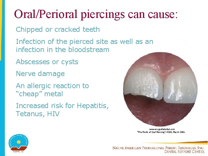 Oral/Perioral piercings can cause: Chipped or cracked teeth Infection of the pierced site as