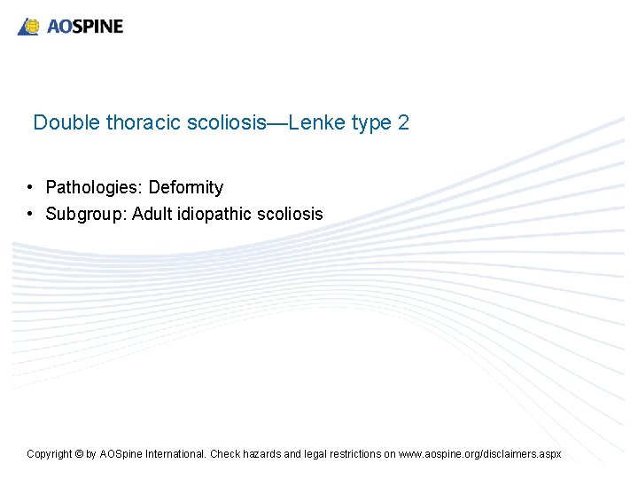 Double thoracic scoliosis—Lenke type 2 • Pathologies: Deformity • Subgroup: Adult idiopathic scoliosis Copyright